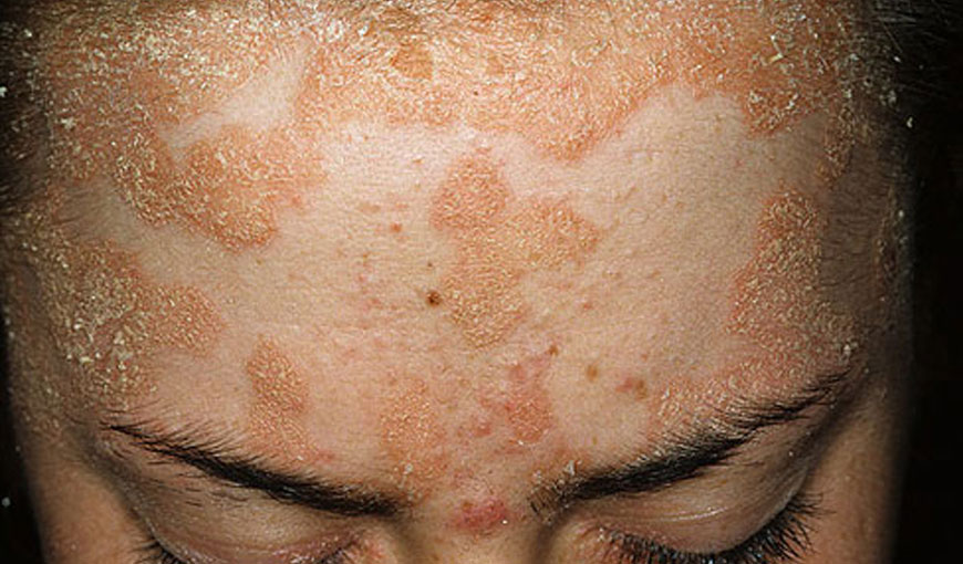 skin_detail Homeopathy Skin Treatment Hyderabad
