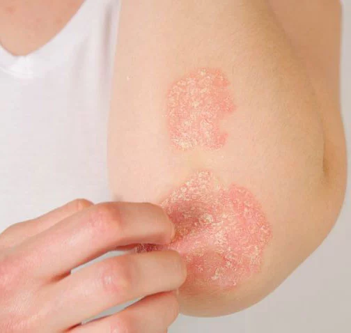 eczema1