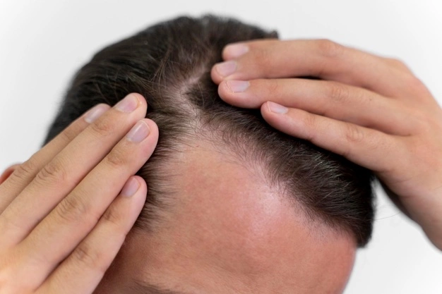 6 Best Homeopathic Medicines for HAIR LOSS DANDRUFF SPLIT HAIR Treatment